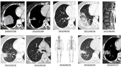 Extensive-Stage Small Cell Carcinoma Transformation From EGFR Del19-Mutant Lung Adenocarcinoma on Gefitinib at the Twelfth-Year Follow-Up Case Report